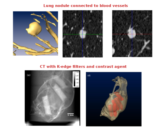 Esempi di immagini dalla nostra attivit&agrave; di ricerca. In alto, la ricostruzione 3D e le sezioni di un nodulo polmonare connesso a un vaso sanguigno, ricostruite da una TAC. In basso, una tecnica di TAC con mezzo di contrasto e con filtri K-edge.
