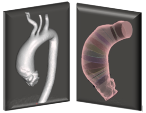L'immagine evidenzia la segmentazione di una radice aortica e identificazione delle sezioni normali