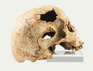 Cranio di San Benedetto di Iglesias con osteoma