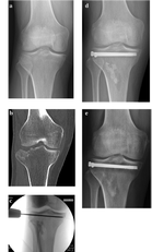 Le fratture al piatto tibiale trattate e studiate dall'equipe cagliaritana