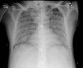 La radiografia di un paziente con insufficienza respiratoria seguito dai professori Caocci e La Nasa