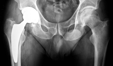 Immagine di protesi d'anca