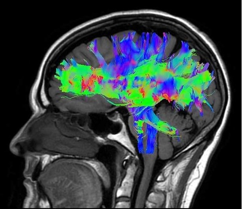 Immagine tridimensionale del cranio con taglio saggitale dell’encefalo ottenuta con tecniche complementari, combinando radiazioni ionizzanti e campi magnetici, solo le prime presentano un rischio per il paziente