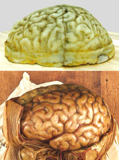 In alto sezione orizzontale di calotta cerebrale lasciata da Rolando nel Museo Anatomico di Sassari al suo ritorno a Torino (2014). La frattura della calotta interessa proprio il solco e le circonvoluzioni pre e post-rolandiche