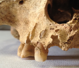 Un pezzo di cranio e calcolo dentale di un individuo maschio del 1800 di 46 anni circa