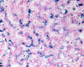 Un vetrino inerente malattie con accumulo di ferro