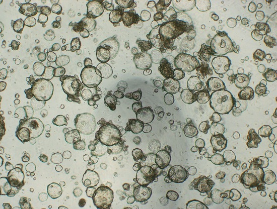 Coltura di organoidi allestita dal laboratorio diretto da Patrizia Zavattari, da tessuto tumorale di un paziente affetto da cancro del colon-retto