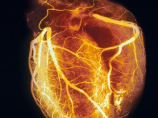 Un'immagine inerente gli studi curati da Juan Carlos Kaski, luminare di cardiologia al St. George's di Londra, ospite del professor Giuseppe Mercuro